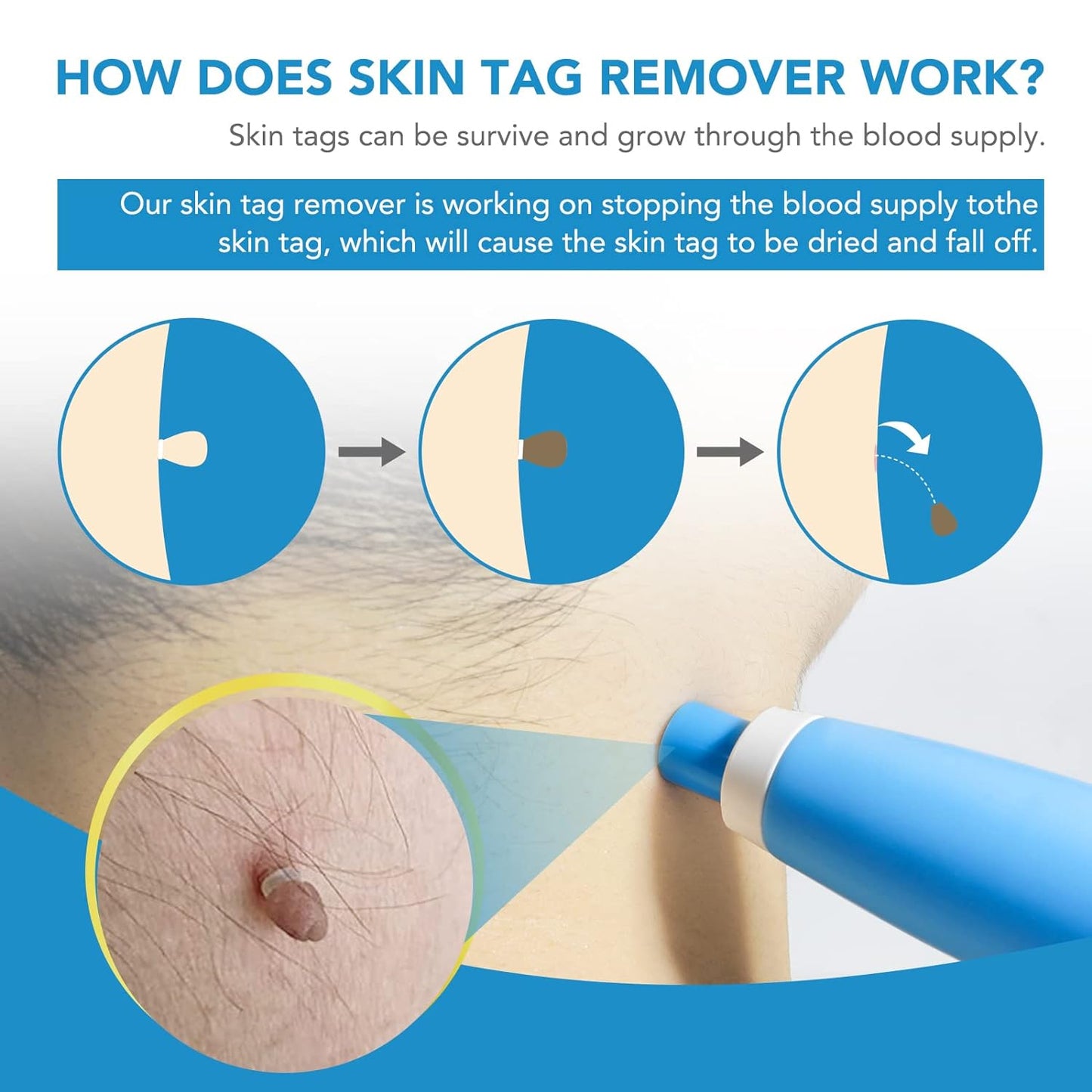 Skin Tag Remover Kit 2 In 1 For Micro To Large (2 Mm - 8 Mm  1 Set)